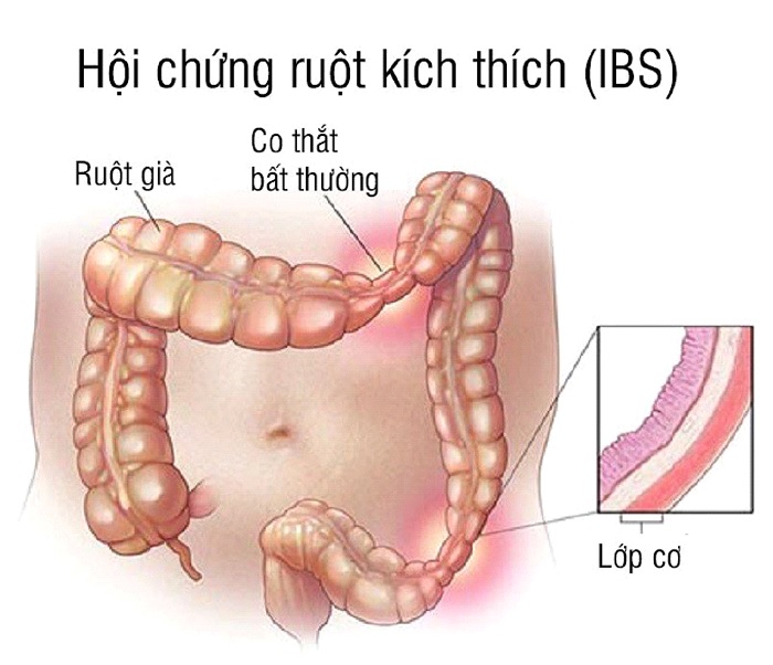 Hội chứng ruột kích thích - Dấu hiệu nhận biết và các phương pháp điều trị