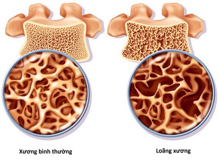 Làm thế nào để biết bạn đang thiếu canxi và khi nào cần bổ sung?